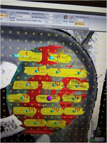 1636445649266570.jpg 图片2、TPS治疗方案.jpg