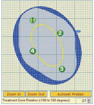 履险如夷之纳米刀肝癌消融